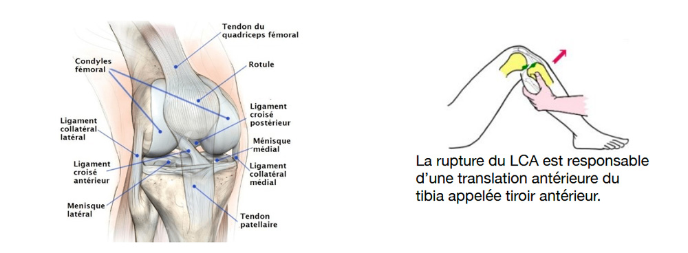 L'entorse grave du genou : Rupture du LCA et ligamentoplastie ...