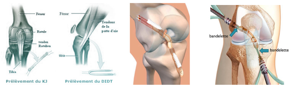 L'entorse grave du genou : Rupture du LCA et ligamentoplastie ...